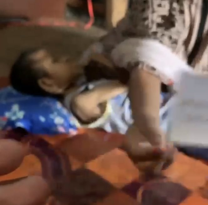 
 Laupe, bocah asal Bojoe, Kelurahan Arawa, Kec watang Pulu Sidrap, terbaring lemah dan didiagnosis gizi buruk.  